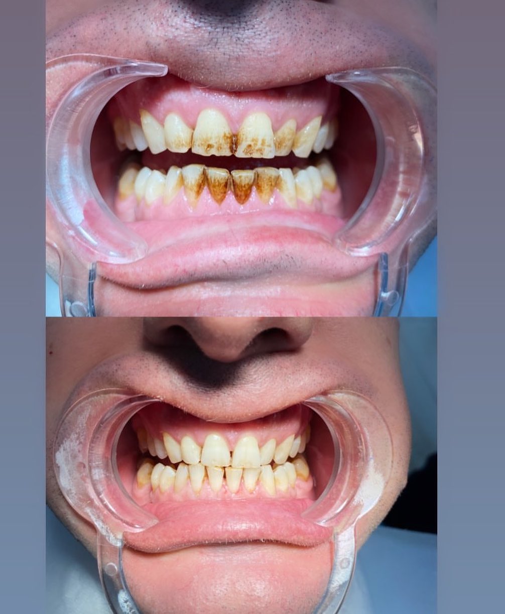 Diş Beyazlatma (Bleaching)
